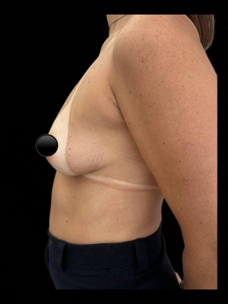 Paciente antes da cirurgia, perfil direito, volume pequeno, sem queda importante, caso operado pelo Dr. Pablo Estrella em Recife